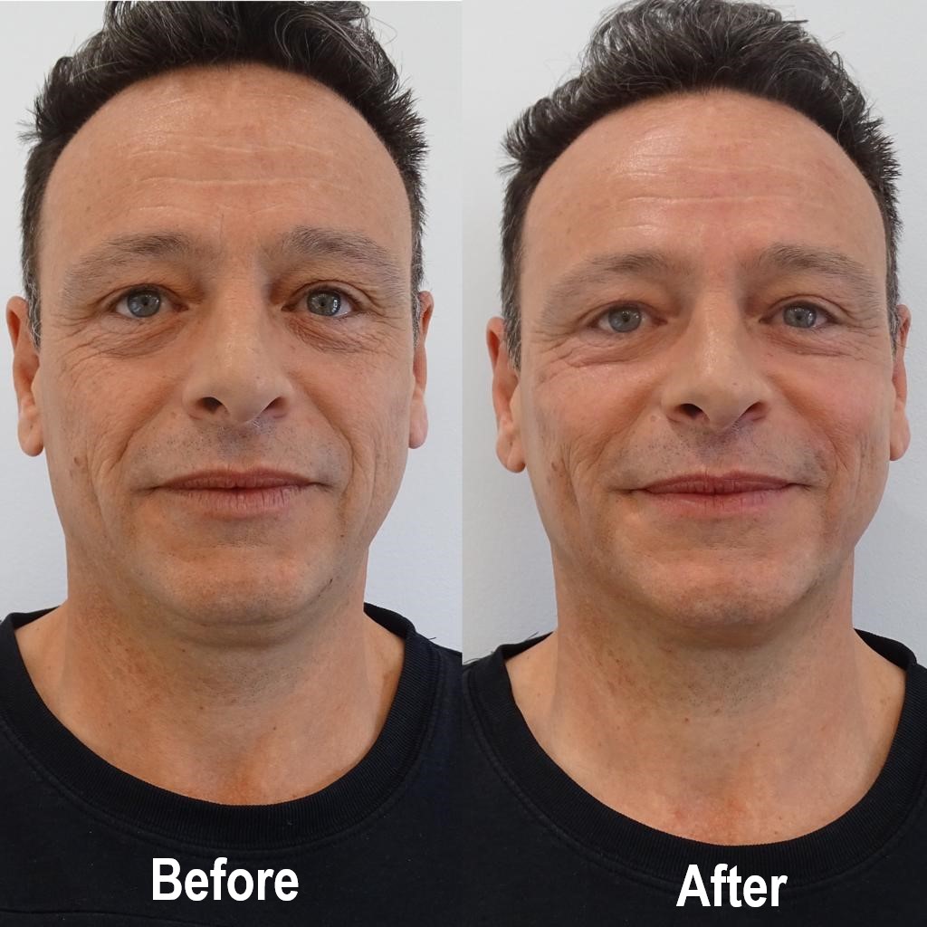 Lines and Wrinkles Treatment