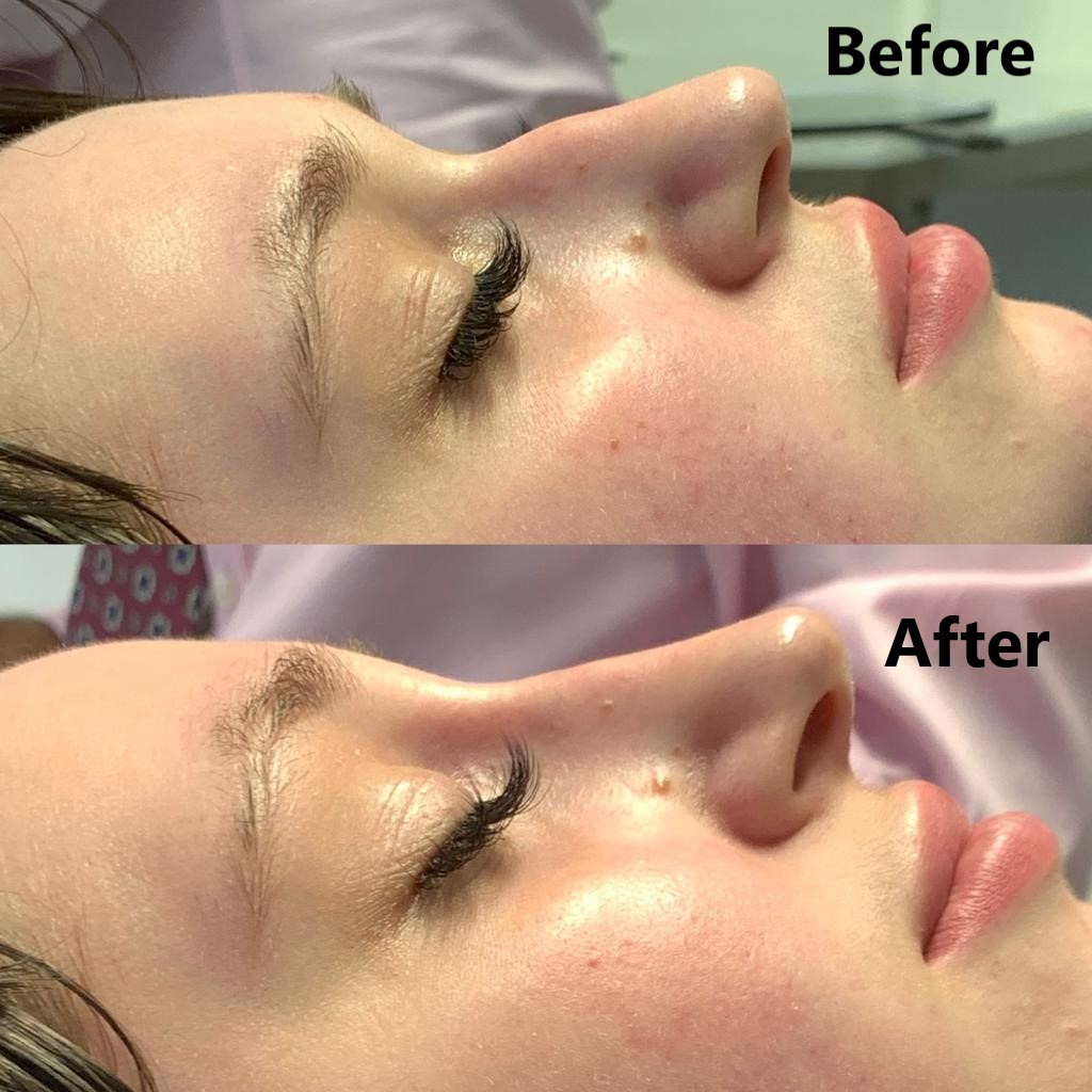 Lines and Wrinkles Treatment