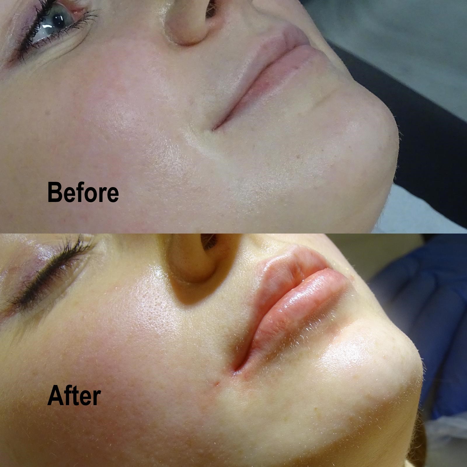 Lines and Wrinkles Treatment